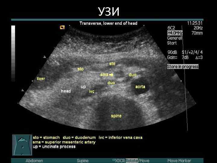 УЗИ 
