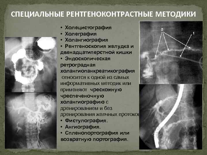 СПЕЦИАЛЬНЫЕ РЕНТГЕНОКОНТРАСТНЫЕ МЕТОДИКИ • Холецистография • Холеграфия • Холангиография • Рентгеноскопия желудка и двенадцатиперстной