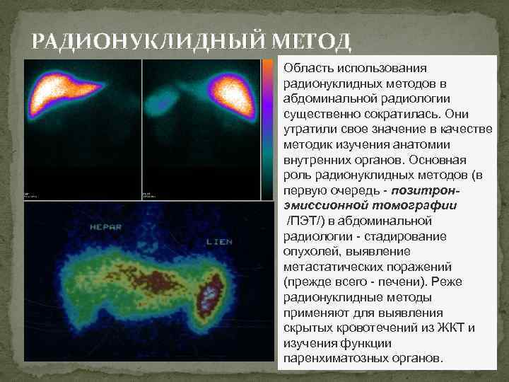 РАДИОНУКЛИДНЫЙ МЕТОД Область использования радионуклидных методов в абдоминальной радиологии существенно сократилась. Они утратили свое