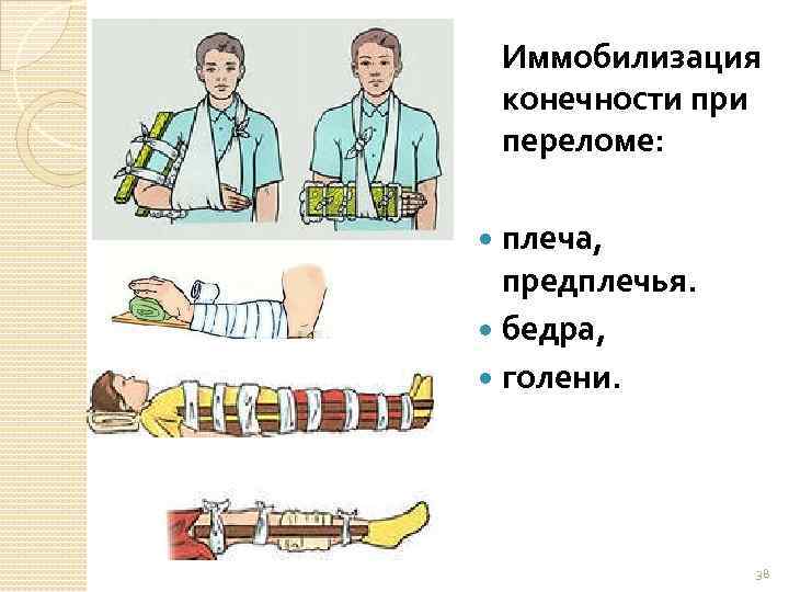 Иммобилизация конечности при переломе: плеча, предплечья. бедра, голени. 38 