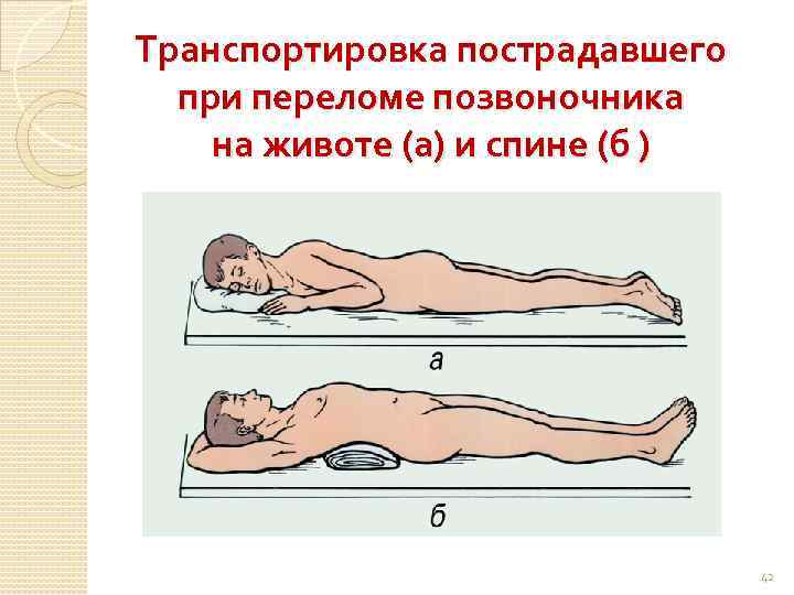 Транспортировка пострадавшего при переломе позвоночника на животе (а) и спине (б ) 42 