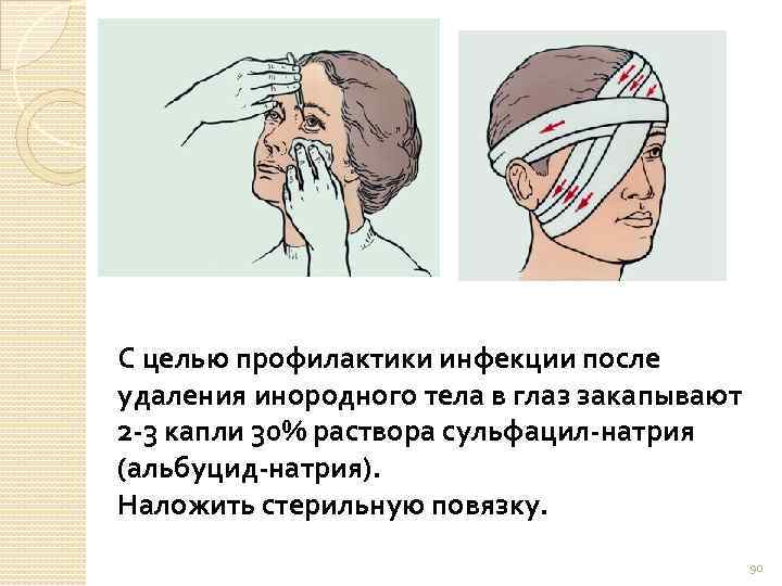 С целью профилактики инфекции после удаления инородного тела в глаз закапывают 2 -3 капли