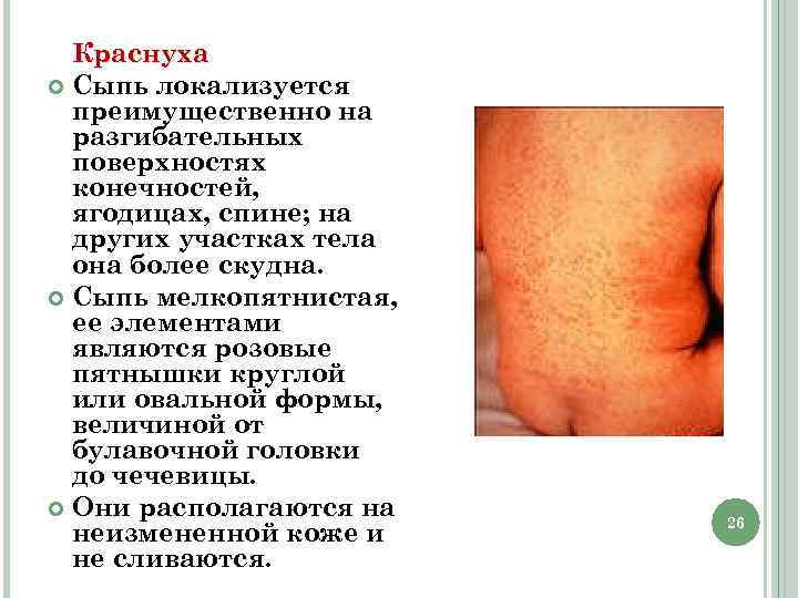 Краснуха Сыпь локализуется преимущественно на разгибательных поверхностях конечностей, ягодицах, спине; на других участках тела