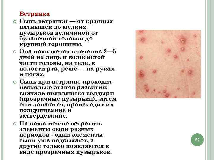  Ветрянка Сыпь ветрянки — от красных пятнышек до мелких пузырьков величиной от булавочной