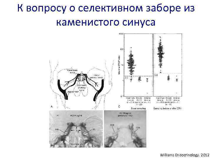 К вопросу о селективном заборе из каменистого синуса Williams Endocrinology. 2012 