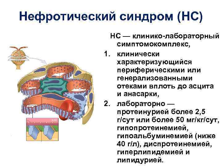 Нефротический синдром (НС) НС — клинико-лабораторный симптомокомплекс, 1. клинически характеризующийся периферическими или генерализованными отеками