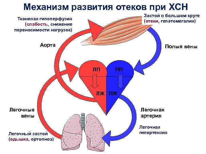 Механизм развития отеков при ХСН Застой в большом круге (отеки, гепатомегалия) Тканевая гипоперфузия (слабость,