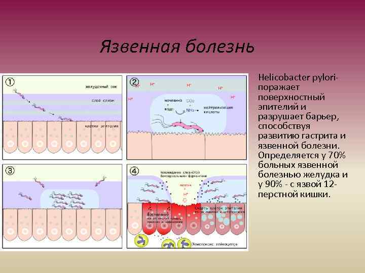 Язвенная болезнь Helicobacter pyloriпоражает поверхностный эпителий и разрушает барьер, способствуя развитию гастрита и язвенной