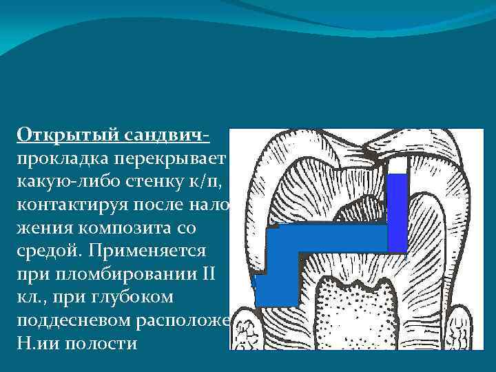 Полость верный. Сэндвич техника пломбирования. Сэндвич техника пломбирования кариозных полостей материалы. Материалы для прокладки при пломбировании кариозных полостей. Этапы пломбирования кариозных полостей.