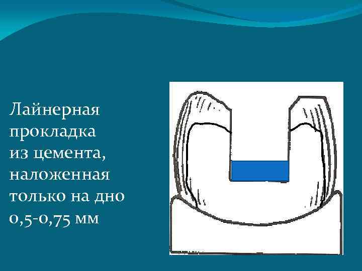 Лайнерная прокладка из цемента, наложенная только на дно 0, 5 -0, 75 мм 