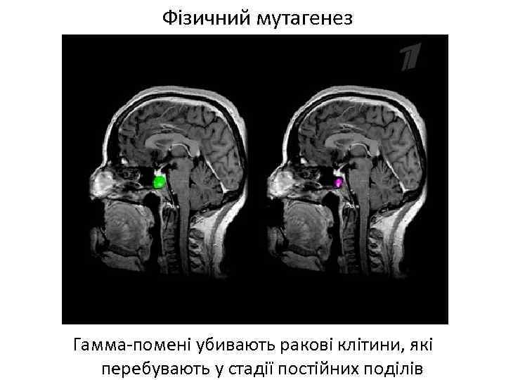 Фізичний мутагенез Гамма-помені убивають ракові клітини, які перебувають у стадії постійних поділів 