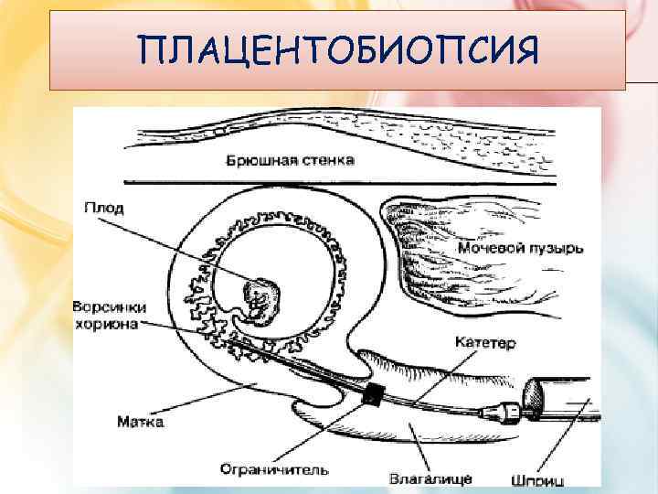 ПЛАЦЕНТОБИОПСИЯ 