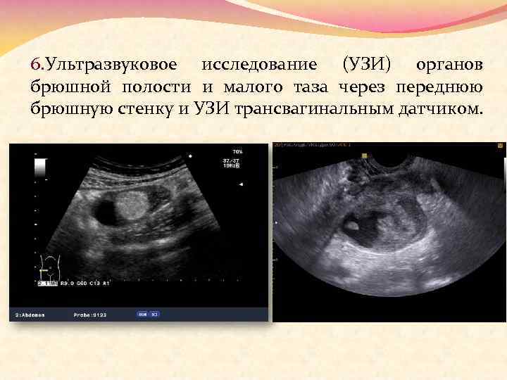 6. Ультразвуковое исследование (УЗИ) органов брюшной полости и малого таза через переднюю брюшную стенку