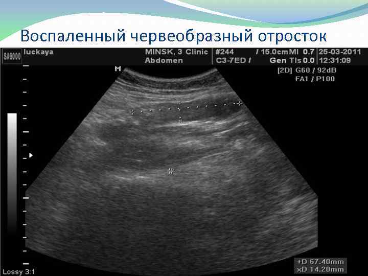 Воспаленный червеобразный отросток 