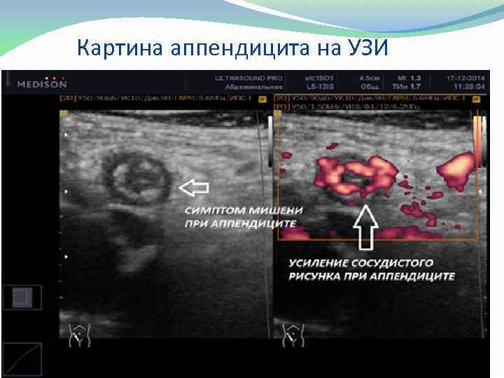 Картина аппендицита на УЗИ 