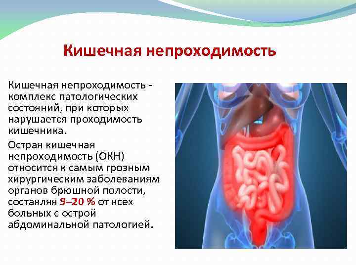 Кишечная непроходимость комплекс патологических состояний, при которых нарушается проходимость кишечника. Острая кишечная непроходимость (ОКН)