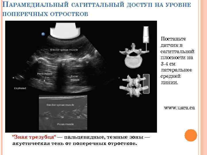 ПАРАМЕДИАЛЬНЫЙ САГИТТАЛЬНЫЙ ДОСТУП НА УРОВНЕ ПОПЕРЕЧНЫХ ОТРОСТКОВ Поставьте датчик в сагиттальной плоскости на 3