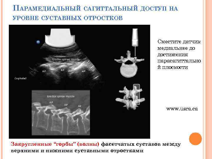 ПАРАМЕДИАЛЬНЫЙ САГИТТАЛЬНЫЙ ДОСТУП НА УРОВНЕ СУСТАВНЫХ ОТРОСТКОВ Сместите датчик медиальнее до достижения парасагиттально й