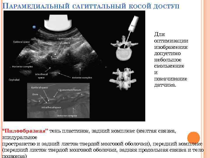 ПАРАМЕДИАЛЬНЫЙ САГИТТАЛЬНЫЙ КОСОЙ ДОСТУП Для оптимизации изображения допустимо небольшое скольжение и покачивание датчика. “Пилообразная”