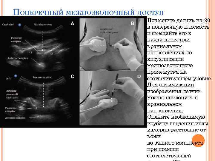 ПОПЕРЕЧНЫЙ МЕЖПОЗВОНОЧНЫЙ ДОСТУП Поверните датчик на 90 в поперечную плоскость и смещайте его в