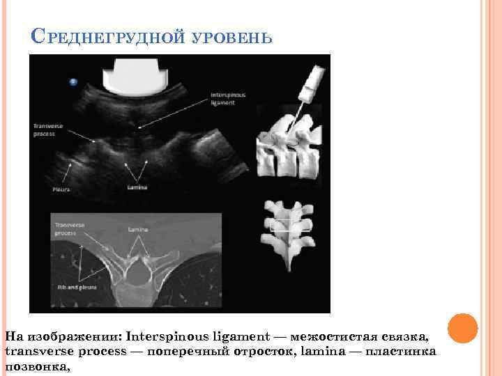 СРЕДНЕГРУДНОЙ УРОВЕНЬ На изображении: Interspinous ligament — межостистая связка, transverse process — поперечный отросток,