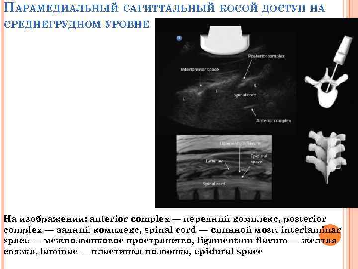 ПАРАМЕДИАЛЬНЫЙ САГИТТАЛЬНЫЙ КОСОЙ ДОСТУП НА СРЕДНЕГРУДНОМ УРОВНЕ На изображении: anterior complex — передний комплекс,