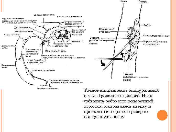 Точное направление эпидуральной иглы. Продольный разрез. Игла «обходит» ребро или поперечный отросток, направляясь кверху