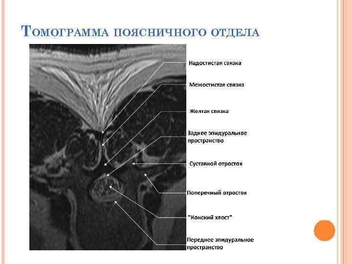 ТОМОГРАММА ПОЯСНИЧНОГО ОТДЕЛА 