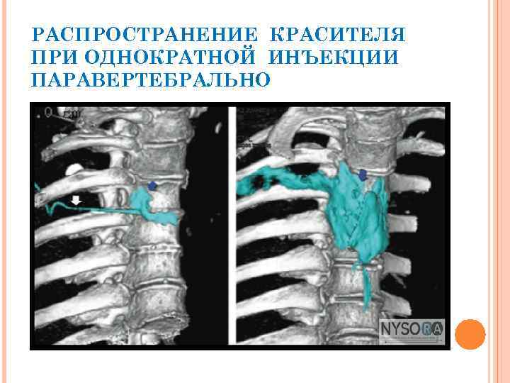 РАСПРОСТРАНЕНИЕ КРАСИТЕЛЯ ПРИ ОДНОКРАТНОЙ ИНЪЕКЦИИ ПАРАВЕРТЕБРАЛЬНО 