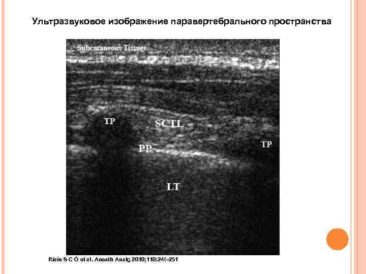 Ультразвуковое изображение паравертебрального пространства Riain S C Ó et al. Anesth Analg 2010; 110: