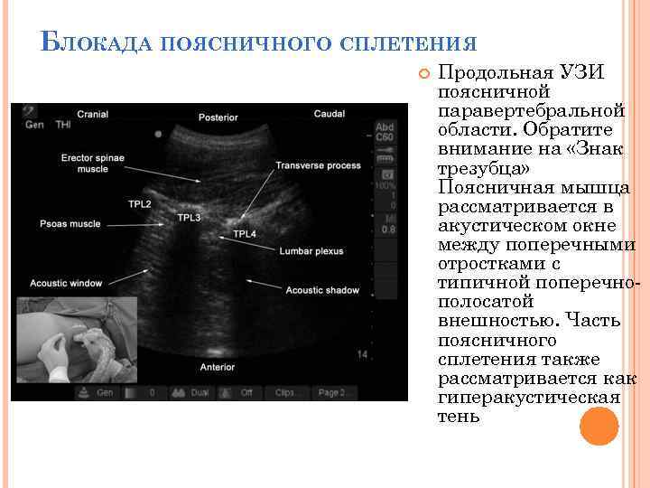 БЛОКАДА ПОЯСНИЧНОГО СПЛЕТЕНИЯ Продольная УЗИ поясничной паравертебральной области. Обратите внимание на «Знак трезубца» Поясничная