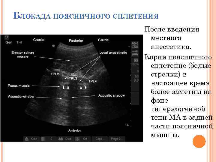 БЛОКАДА ПОЯСНИЧНОГО СПЛЕТЕНИЯ После введения местного анестетика. Корни поясничного сплетение (белые стрелки) в настоящее