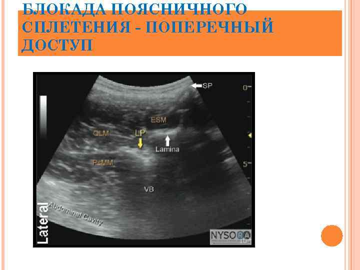 БЛОКАДА ПОЯСНИЧНОГО СПЛЕТЕНИЯ - ПОПЕРЕЧНЫЙ ДОСТУП 