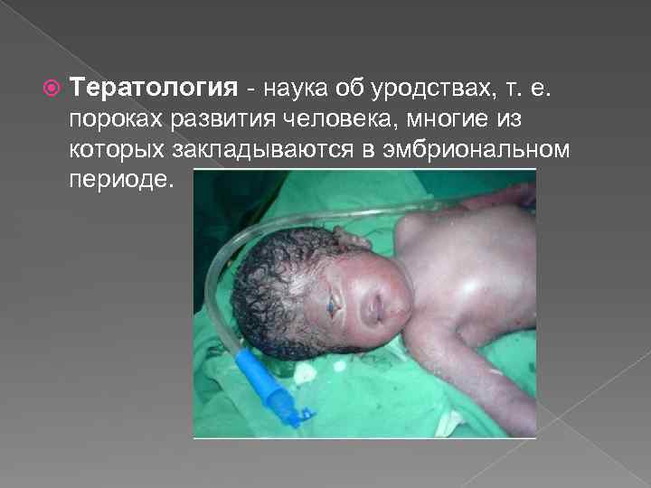 Тератология - наука об уродствах, т. е. пороках развития человека, многие из которых