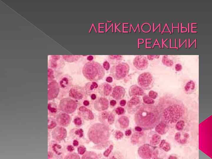 ЛЕЙКЕМОИДНЫЕ РЕАКЦИИ 
