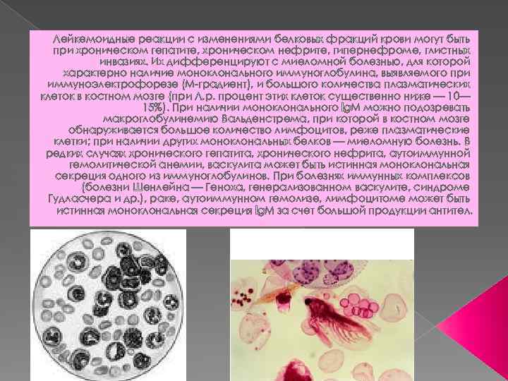  Лейкемоидные реакции с изменениями белковых фракций крови могут быть при хроническом гепатите, хроническом