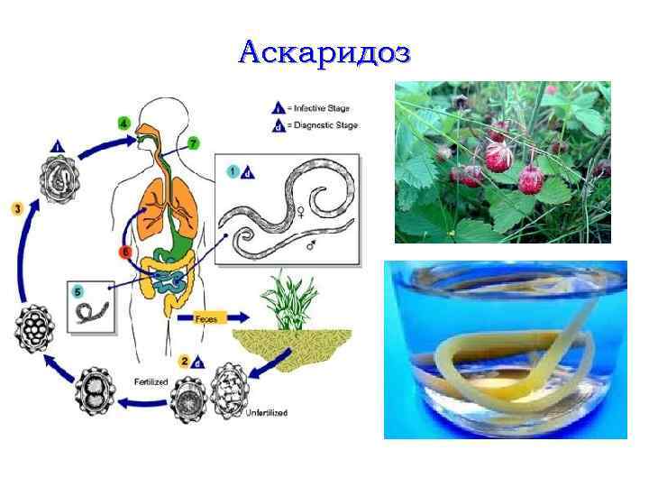 Аскаридоз 