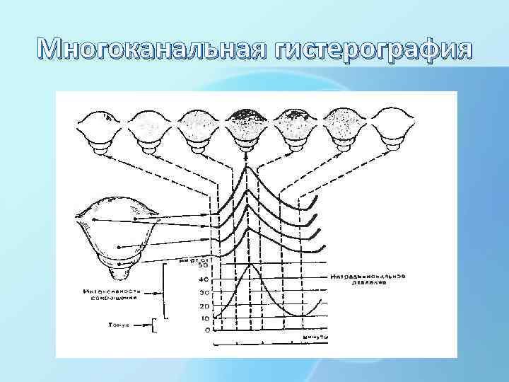 Многоканальная гистерография 