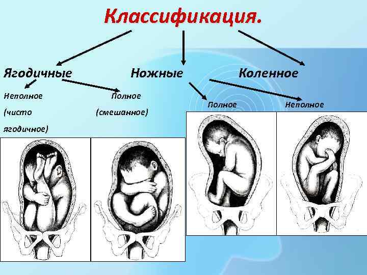 Классификация. Ягодичные Неполное (чисто ягодичное) Ножные Полное (смешанное) Коленное Полное Неполное 