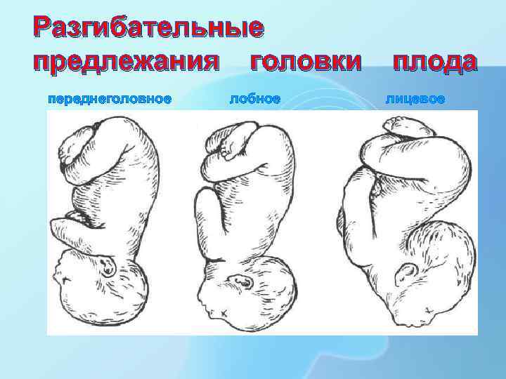 Разгибательные предлежания головки переднеголовное лобное плода лицевое 