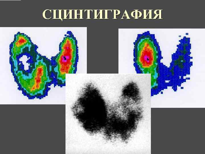 Сцинтиграфия щитовидной железы это