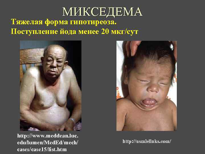 МИКСЕДЕМА Тяжелая форма гипотиреоза. Поступление йода менее 20 мкг/сут http: //www. meddean. luc. edu/lumen/Med.