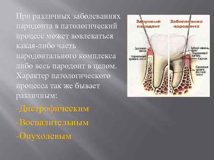 При различных заболеваниях пародонта в патологический процесс может вовлекаться какая-либо часть пародонтального комплекса либо