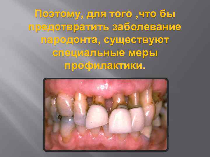 Поэтому, для того , что бы предотвратить заболевание пародонта, существуют специальные меры профилактики. 