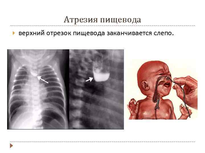 Атрезия пищевода верхний отрезок пищевода заканчивается слепо. 