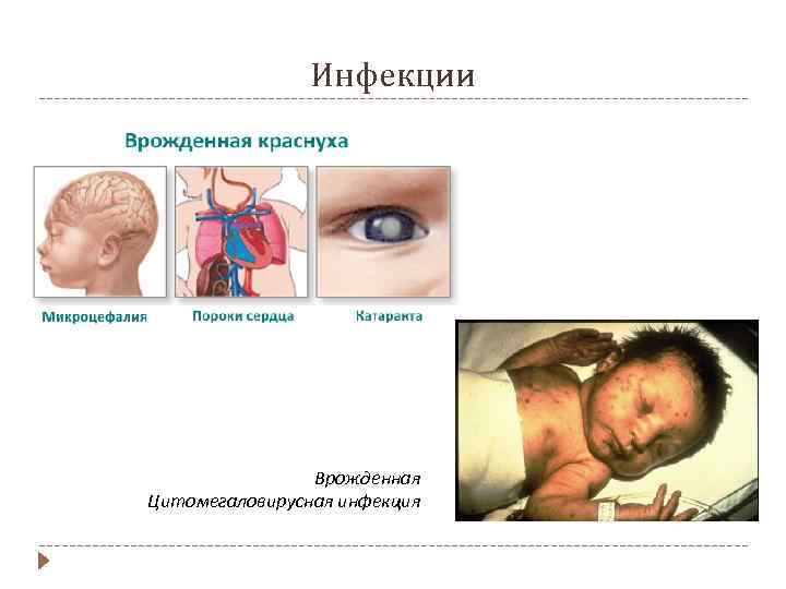 Инфекции Врожденная Цитомегаловирусная инфекция 