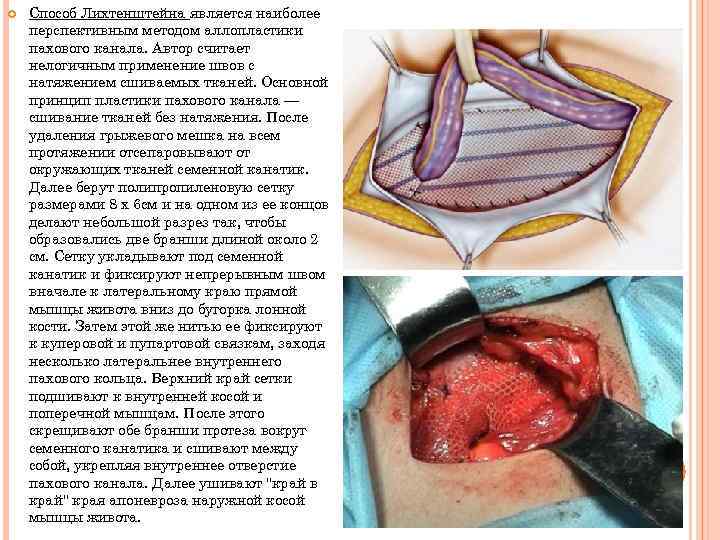  Способ Лихтенштейна является наиболее перспективным методом аллопластики пахового канала. Автор считает нелогичным применение