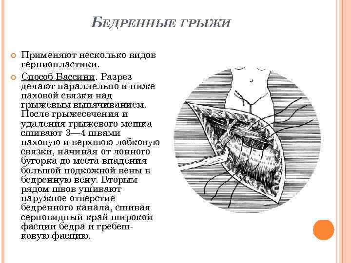 Пластика бедренного канала