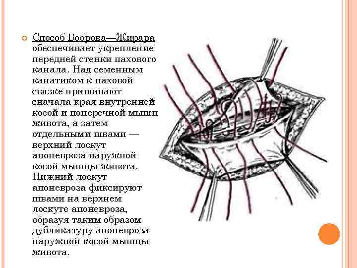 Пластика пахового канала по жирару