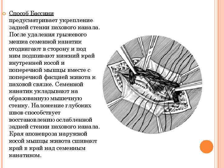 Способ кукуджанова при паховых грыжах схема - 80 фото